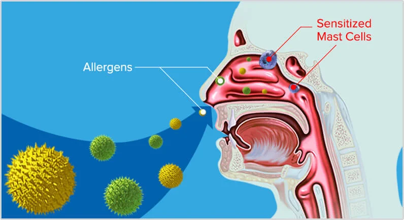 Nasal allergy discount